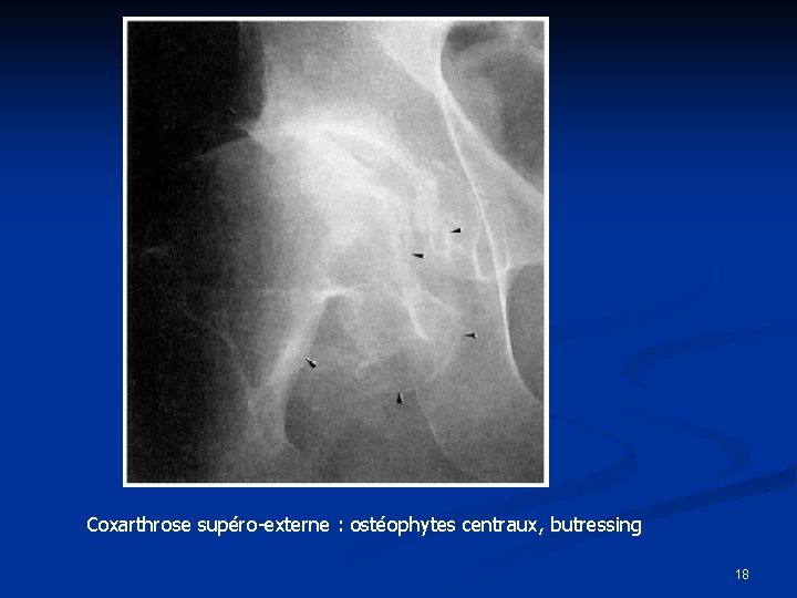 Coxarthrose supéro-externe : ostéophytes centraux, butressing 18 