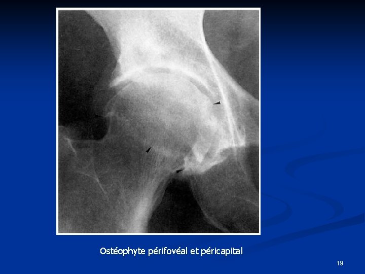 Ostéophyte périfovéal et péricapital 19 
