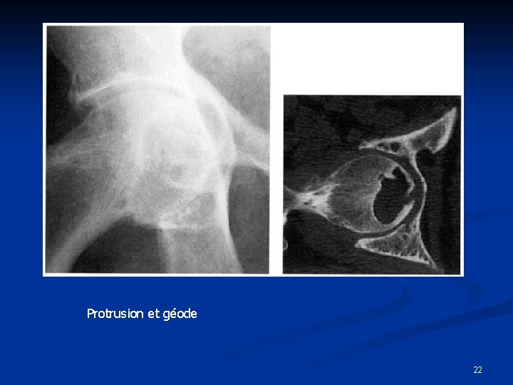 Protrusion et géode 22 