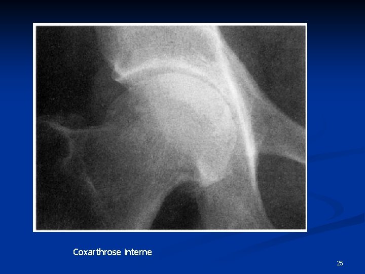 Coxarthrose interne 25 