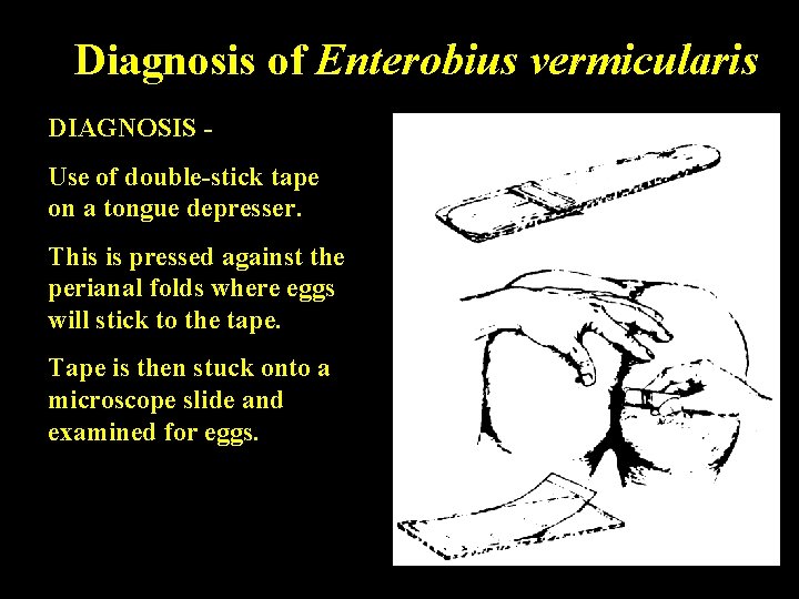 Diagnosis of Enterobius vermicularis DIAGNOSIS Use of double-stick tape on a tongue depresser. This Diagnosis of Enterobius vermicularis DIAGNOSIS Use of double-stick tape on a tongue depresser. This