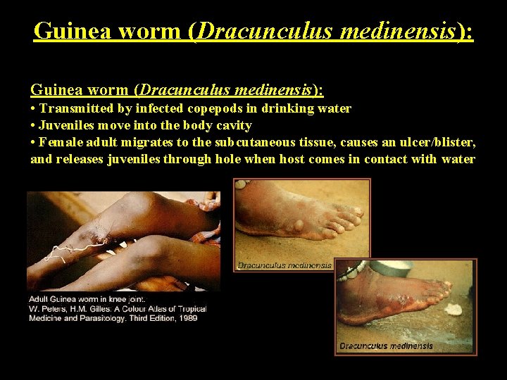 Guinea worm (Dracunculus medinensis): • Transmitted by infected copepods in drinking water • Juveniles Guinea worm (Dracunculus medinensis): • Transmitted by infected copepods in drinking water • Juveniles