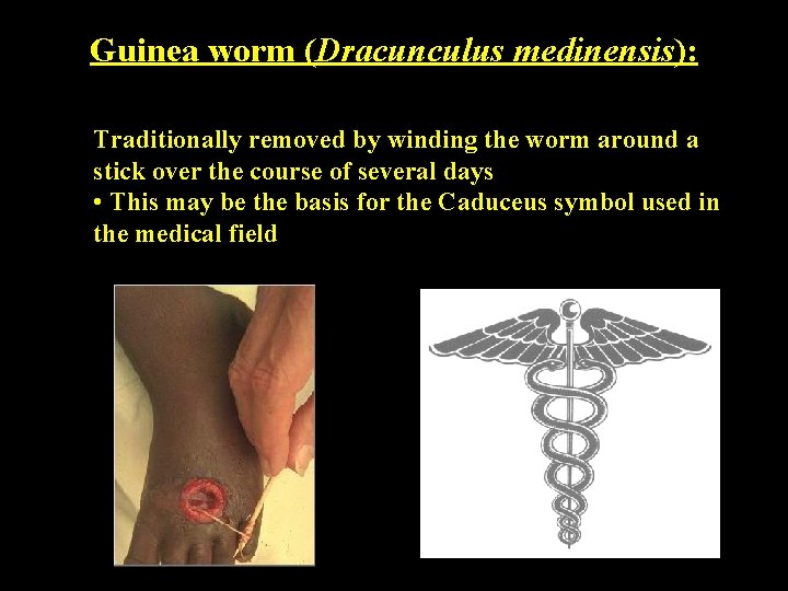 Guinea worm (Dracunculus medinensis): Traditionally removed by winding the worm around a stick over Guinea worm (Dracunculus medinensis): Traditionally removed by winding the worm around a stick over