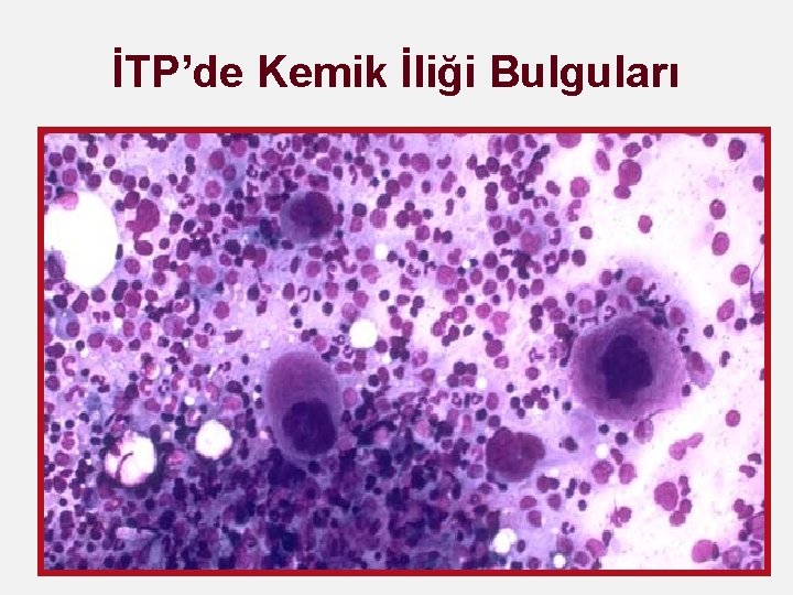 İTP’de Kemik İliği Bulguları 