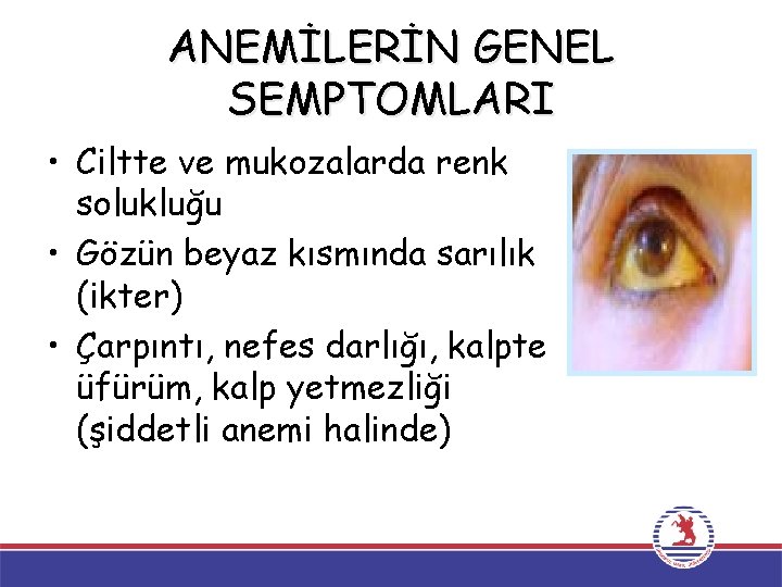 ANEMİLERİN GENEL SEMPTOMLARI • Ciltte ve mukozalarda renk solukluğu • Gözün beyaz kısmında sarılık