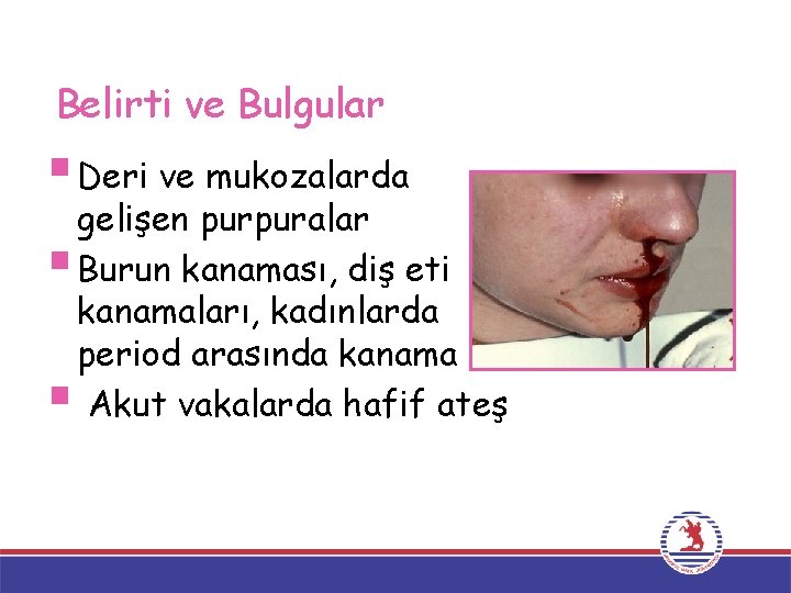 Belirti ve Bulgular § Deri ve mukozalarda § § gelişen purpuralar Burun kanaması, diş