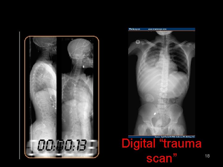 Stat scan total body Is this the future of radiography? ? ? Digital “trauma