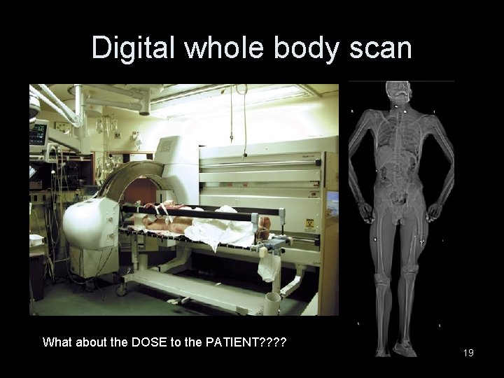 Digital whole body scan What about the DOSE to the PATIENT? ? 19 