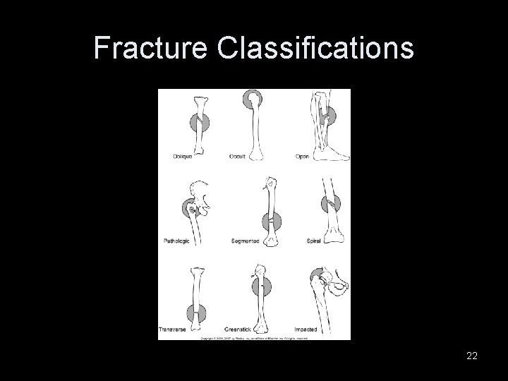 Fracture Classifications 22 