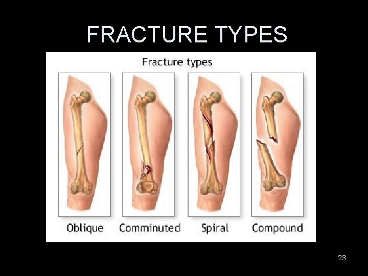 FRACTURE TYPES 23 