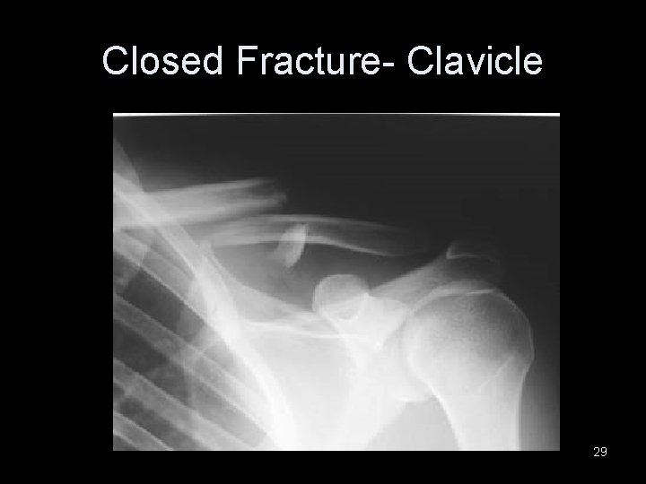 Closed Fracture- Clavicle 29 