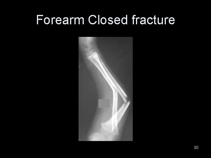 Forearm Closed fracture 30 