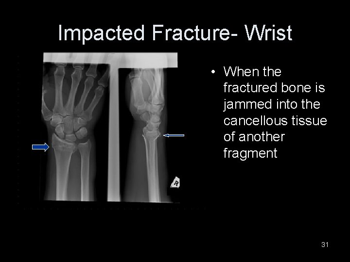 Impacted Fracture- Wrist • When the fractured bone is jammed into the cancellous tissue