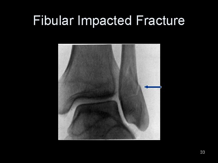 Fibular Impacted Fracture 33 