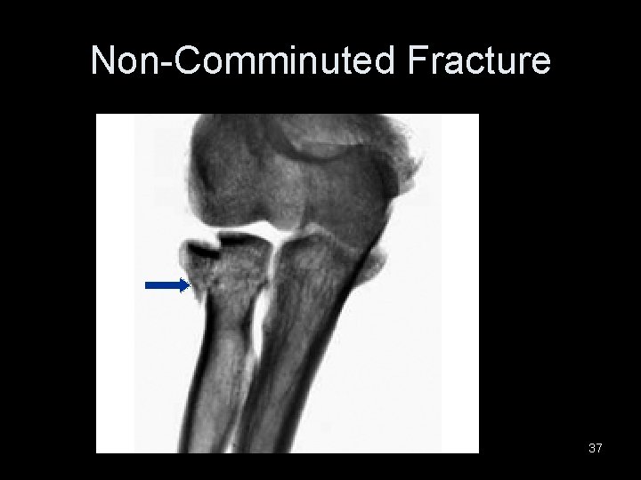 Non-Comminuted Fracture 37 