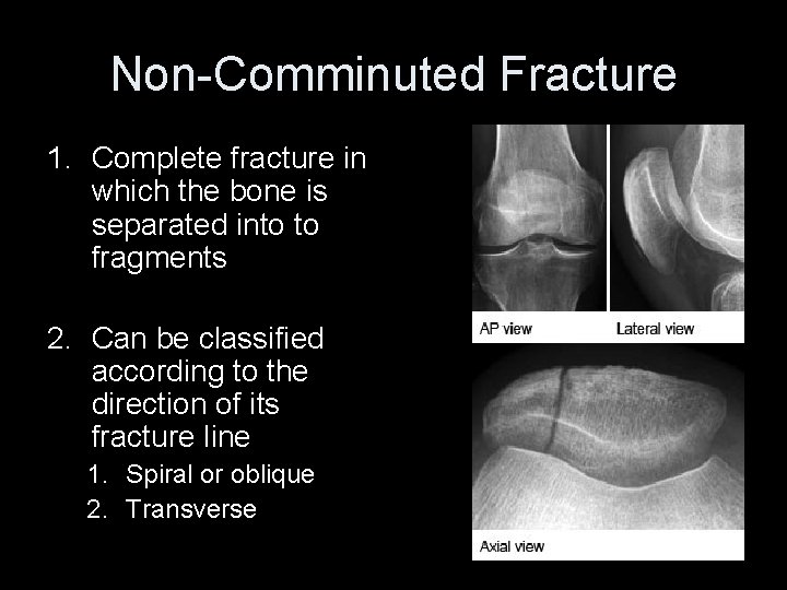 Non-Comminuted Fracture 1. Complete fracture in which the bone is separated into to fragments