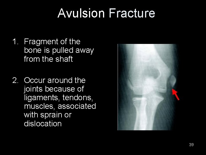 Avulsion Fracture 1. Fragment of the bone is pulled away from the shaft 2.