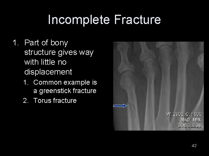 Incomplete Fracture 1. Part of bony structure gives way with little no displacement 1.