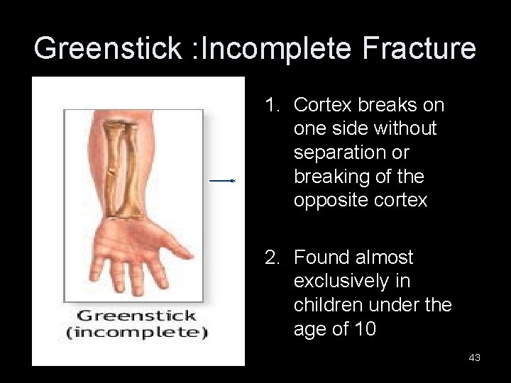 Greenstick : Incomplete Fracture 1. Cortex breaks on one side without separation or breaking