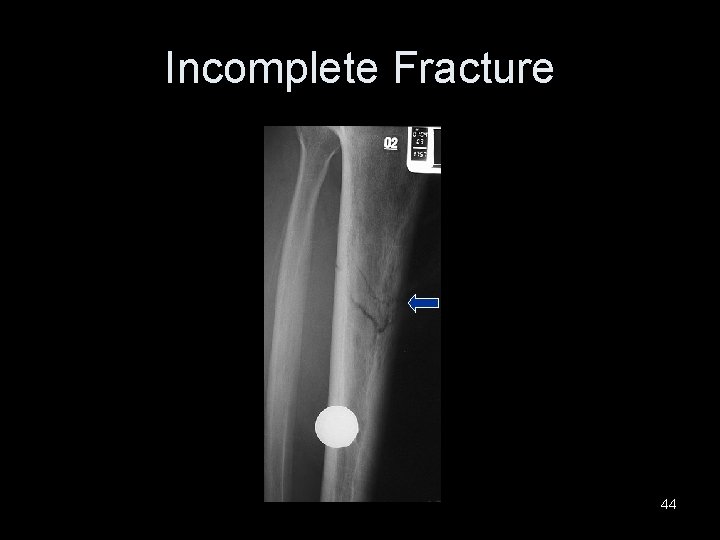 Incomplete Fracture 44 