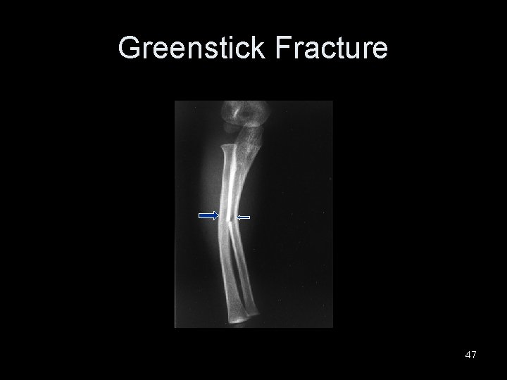 Greenstick Fracture 47 