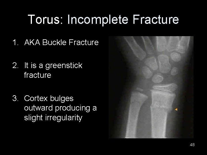 Torus: Incomplete Fracture 1. AKA Buckle Fracture 2. It is a greenstick fracture 3.