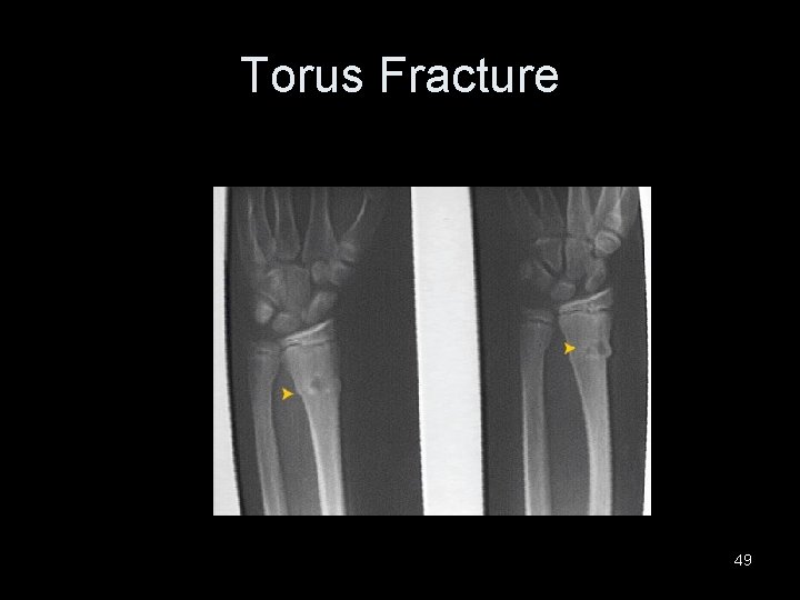 Torus Fracture 49 