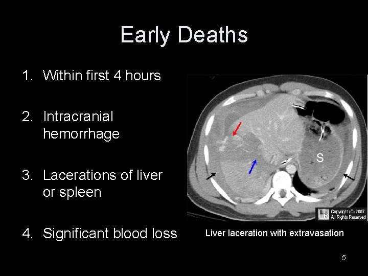Early Deaths 1. Within first 4 hours 2. Intracranial hemorrhage 3. Lacerations of liver