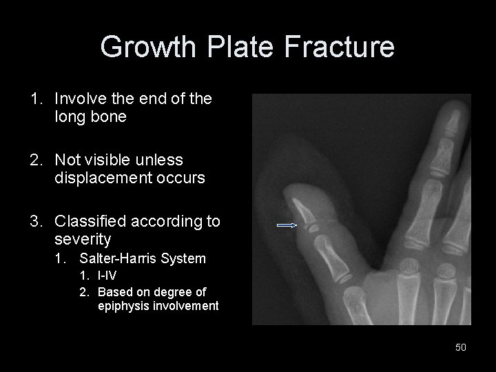 Growth Plate Fracture 1. Involve the end of the long bone 2. Not visible