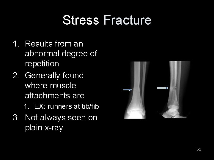 Stress Fracture 1. Results from an abnormal degree of repetition 2. Generally found where