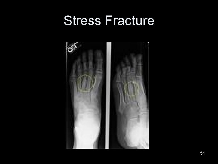 Stress Fracture 54 