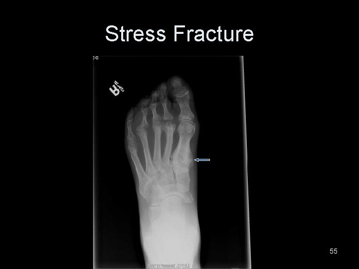 Stress Fracture 55 