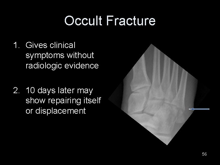Occult Fracture 1. Gives clinical symptoms without radiologic evidence 2. 10 days later may