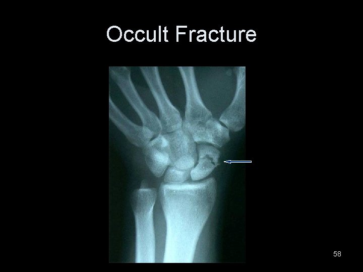Occult Fracture 58 