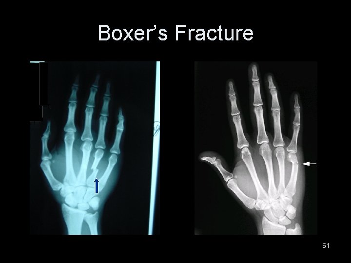 Boxer’s Fracture 61 