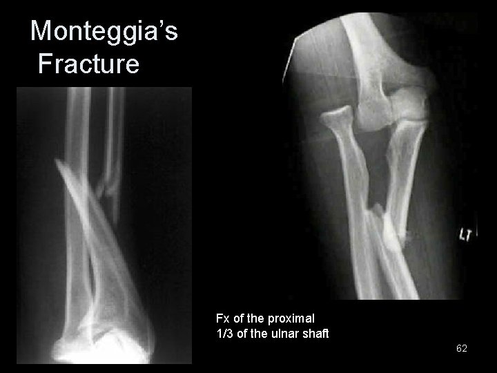 Monteggia’s Fracture Fx of the proximal 1/3 of the ulnar shaft 62 