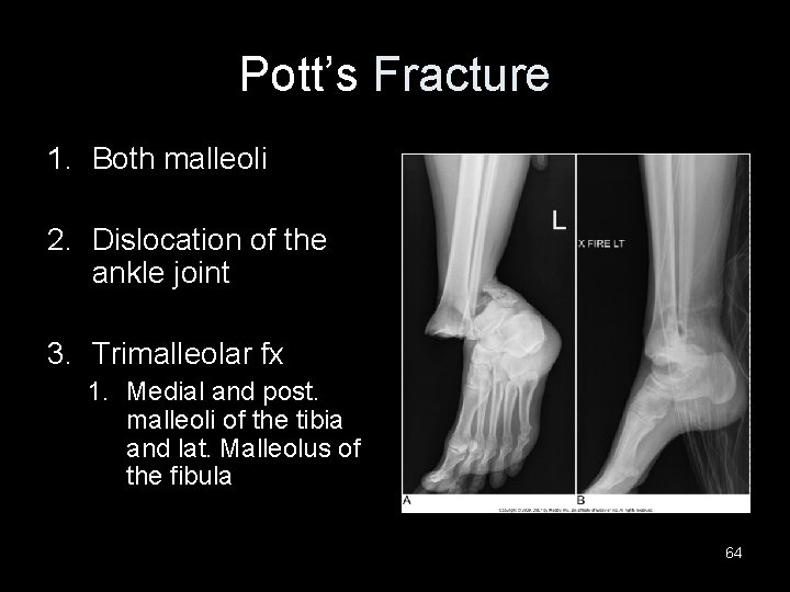 Pott’s Fracture 1. Both malleoli 2. Dislocation of the ankle joint 3. Trimalleolar fx