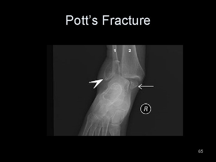Pott’s Fracture 65 