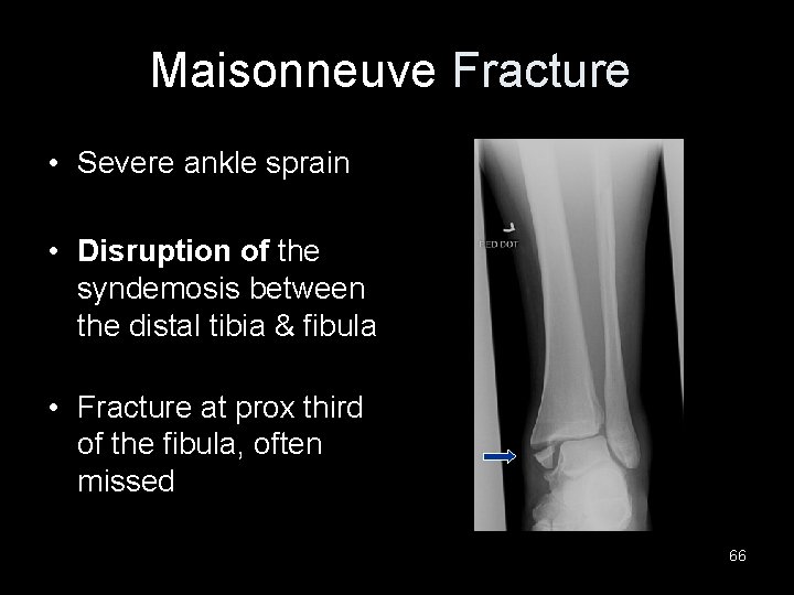 Maisonneuve Fracture • Severe ankle sprain • Disruption of the syndemosis between the distal