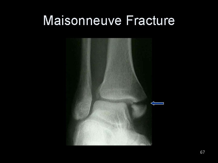 Maisonneuve Fracture 67 