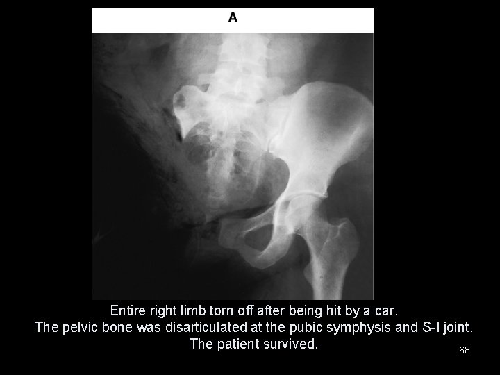 Entire right limb torn off after being hit by a car. The pelvic bone