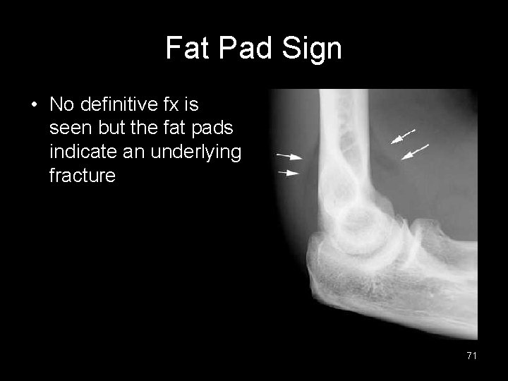 Fat Pad Sign • No definitive fx is seen but the fat pads indicate