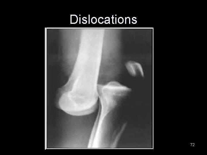 Dislocations 72 