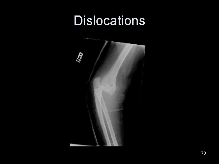 Dislocations 73 