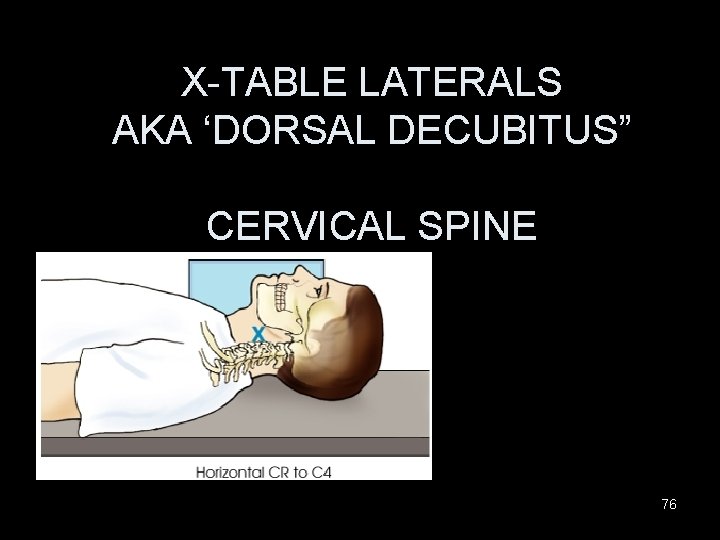 X-TABLE LATERALS AKA ‘DORSAL DECUBITUS” CERVICAL SPINE 76 