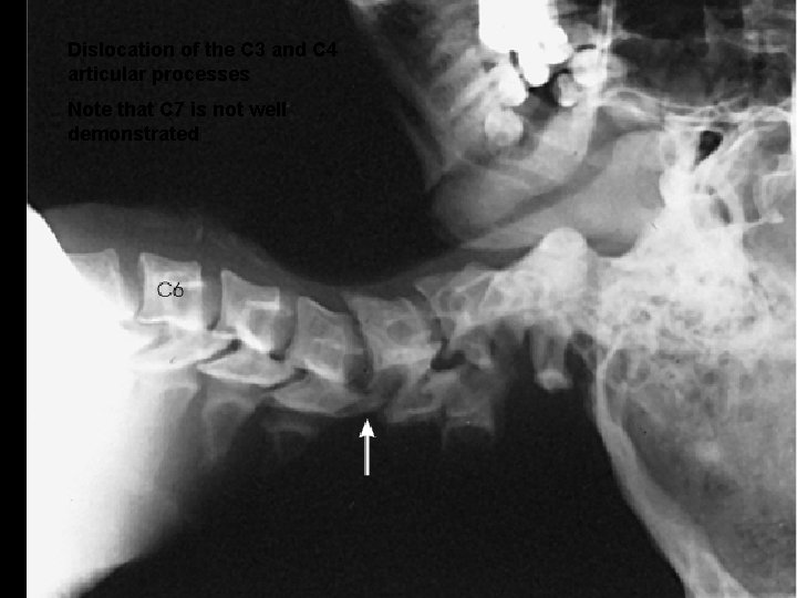 Dislocation of the C 3 and C 4 articular processes Note that C 7