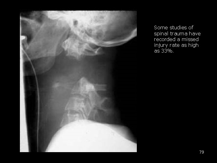 Some studies of spinal trauma have recorded a missed injury rate as high as