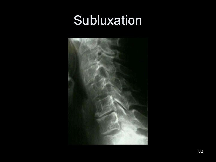 Subluxation 82 