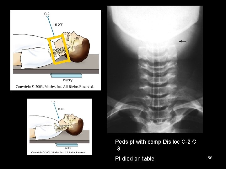 Peds pt with comp Dis loc C-2 C -3 Pt died on table 85