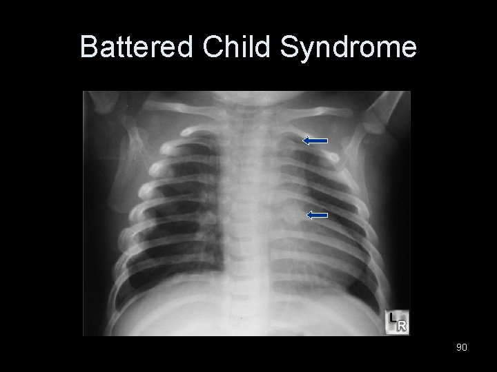 Battered Child Syndrome 90 